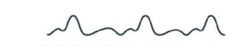<p><strong>Q:</strong> What does delta frequency represent in EEG?</p>