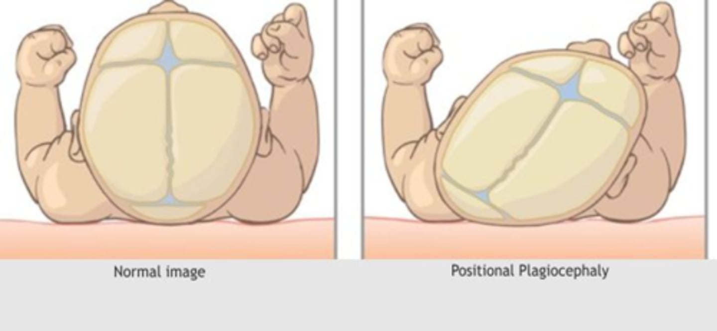 <p>occurs when infant lies on one side more than the other</p><p>disappears as baby becomes more active</p>