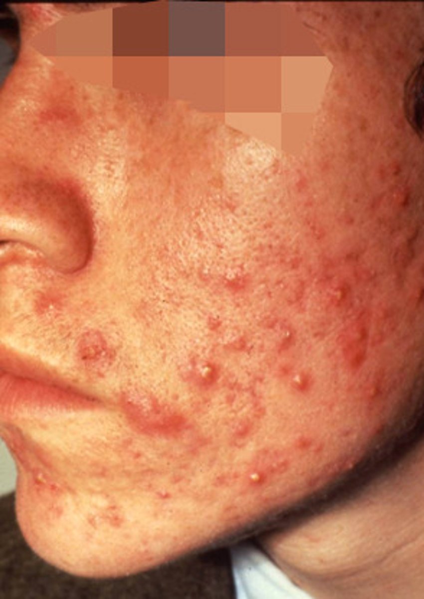<p>common type of acne. Sebaceous glans produce excessive oil which blocks pores. Bacteria builds up in oil.</p>