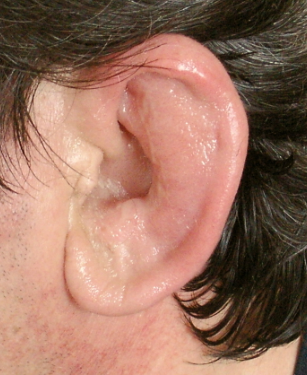 <p>Which is a possible treatment for this condition? Antibiotics or reconstruction?</p>