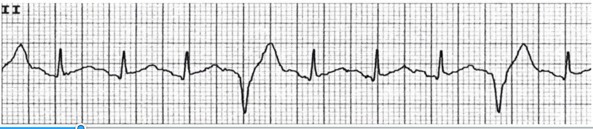 <p>What does this EKG represent?</p>