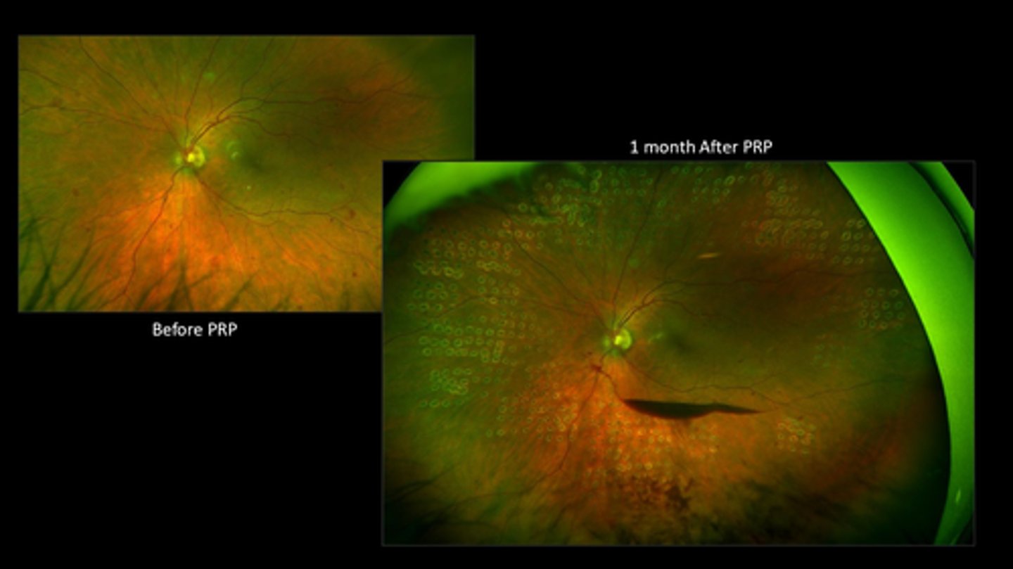 <p>Why are vitreous hemes sometimes a side effect of PRP?</p>