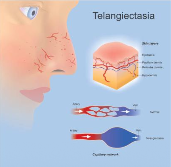 <p>What is telangiectasia?</p>