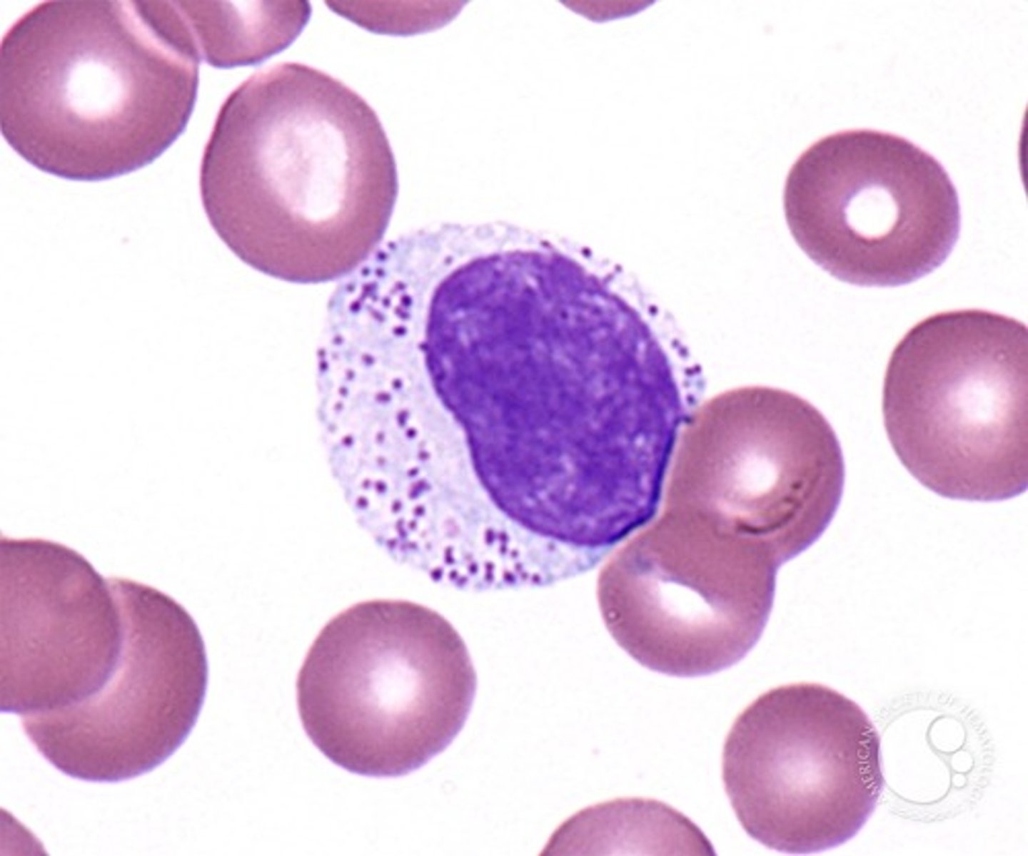 <p>a clonal disease of the large granular lymphocyte characterized by peripheral blood and marrow lymphocytic infiltration with LGLs, splenomegaly, and cytopenias, most commonly neutropenia</p>