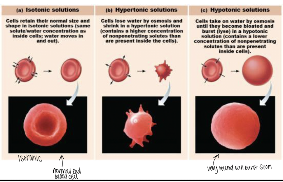 Tonicity: solution changes cell shape by from water volume shifts


1. isolotic soltuion: same osmolarity as inside the cell

   
   1. no change- most IV liquids
2. hypertonic solution: higher osmolarity than inside cell 

   
   1. water flows out > shrinks the cell *crenation*
3. hypotonic solution: lower osmolarity than inside the cell 

   
   1. water flows into cell > cell swelling *cell burst>lysing/lysis* 