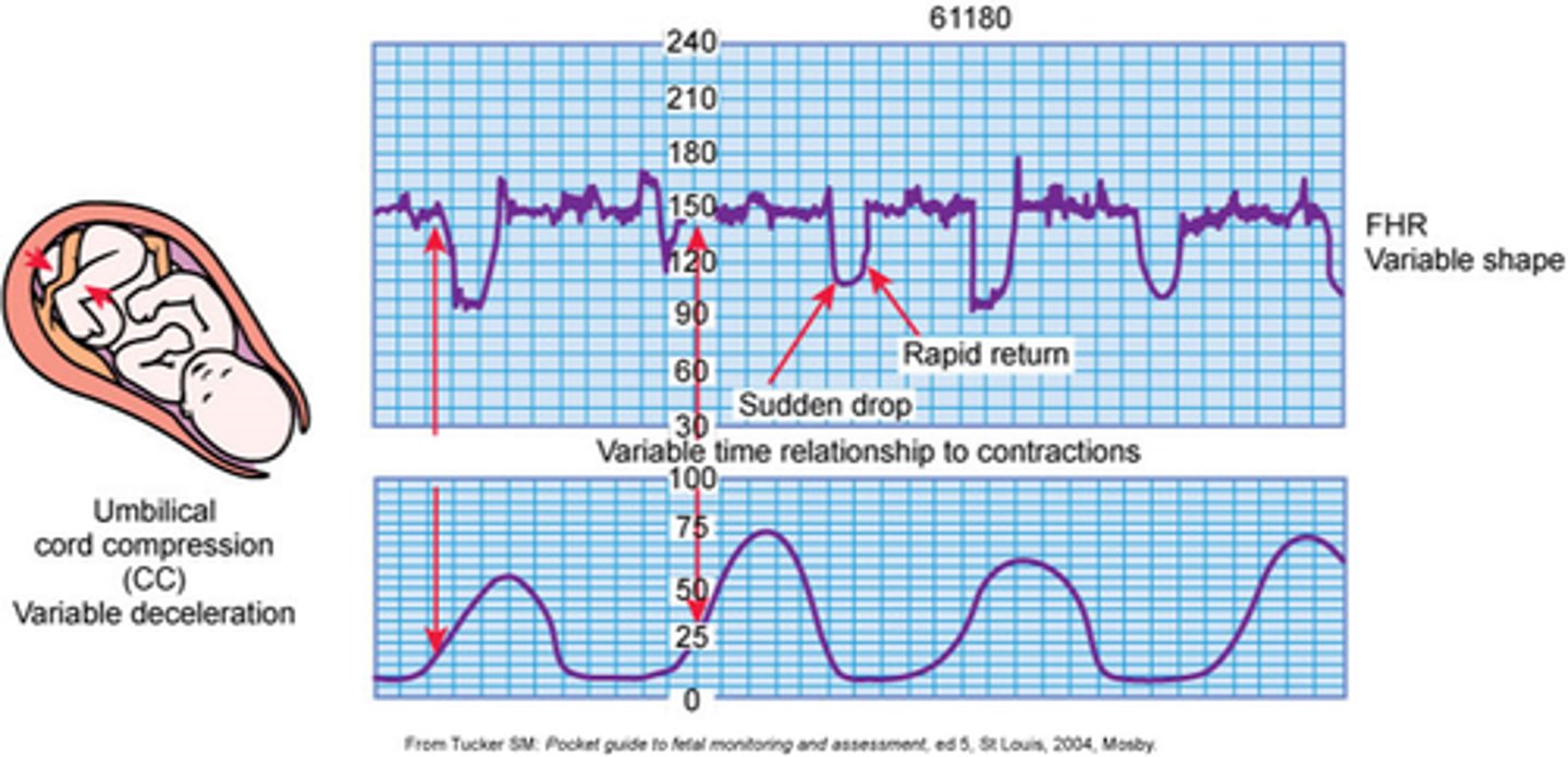 <p>cord compression</p>