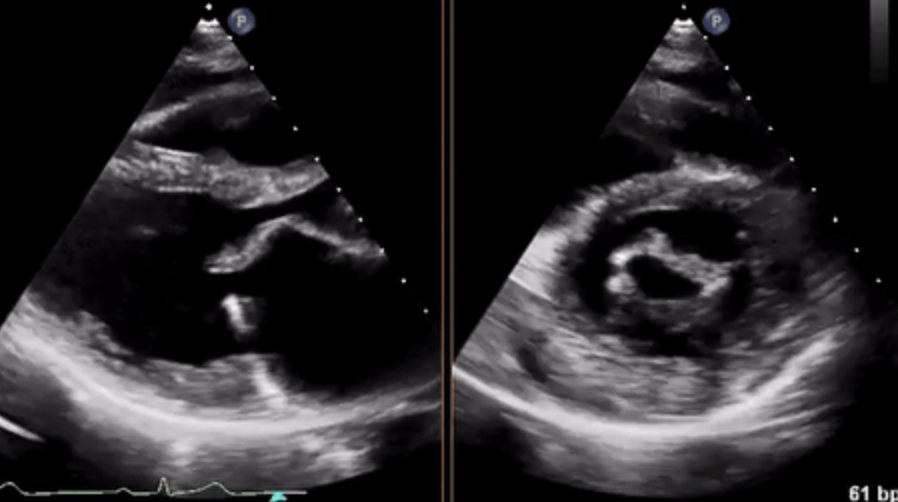 <p>What pathology is seen on this video clip</p>