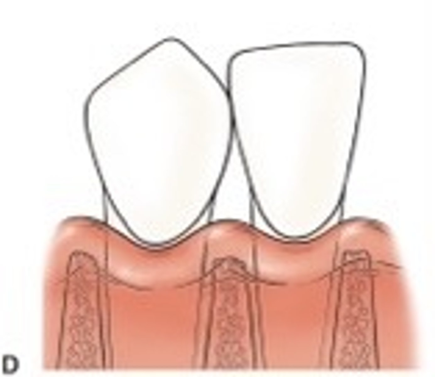 <p>The interdental papilla is at or apical to the level of the facial CEJ.&nbsp;Papilla completely missing</p>
