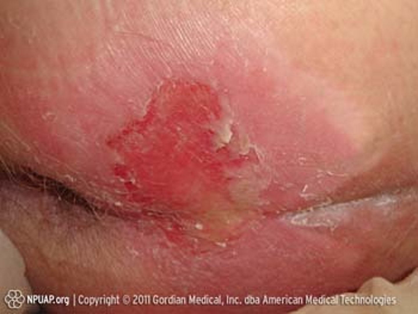 <p>diagnose this:</p><p>Partial or full skin breakdown due to prolonged pressure</p>