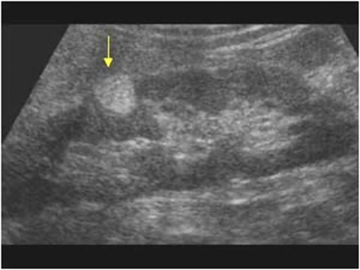 <p>Angiomyolipoma (AML) occurrence:</p><p>80% in ___</p><p>80% in ___</p><p>80% in ___ </p><p></p>