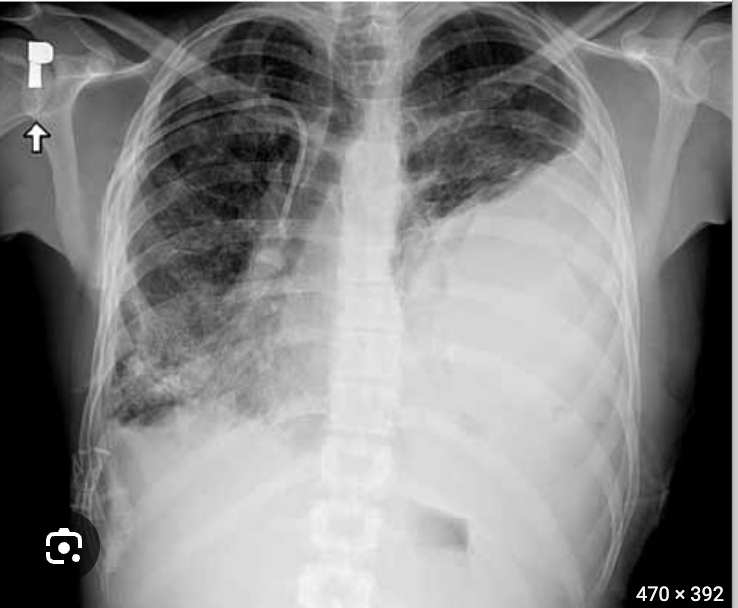 <p>An accumulation of blood in the pleural space that leads to HYPOresonance and decreased breath sounds</p>