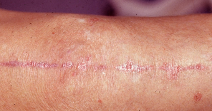 <p>appearance of new skin lesions on previously unaffected skin secondary to trauma</p>