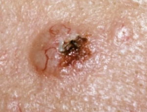 <p>What is basal cell carcinoma (BCC) caused by?</p>