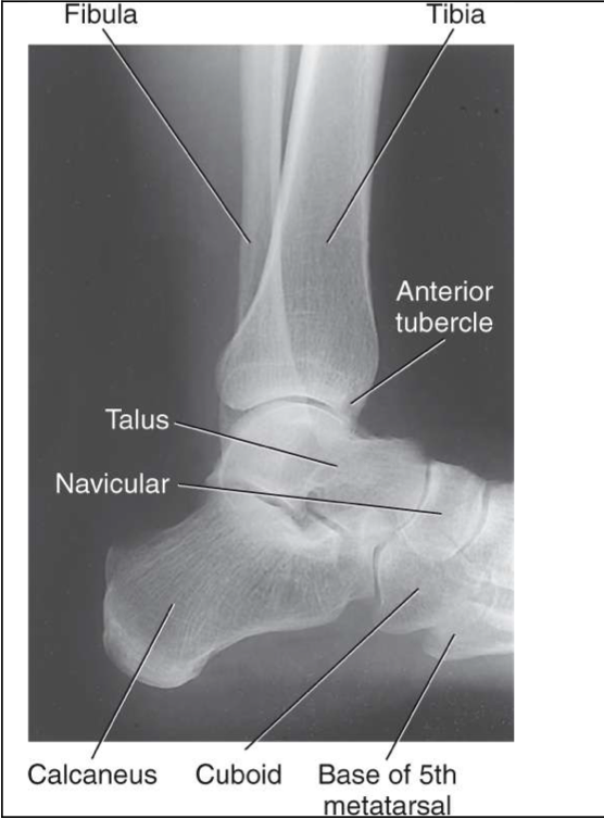 <p><span style="line-height: normal;"><span> </span></span>Entire talus and calcaneus visualized</p><p class="p1"><span style="line-height: normal;"><span> </span></span>Base of 5<span style="line-height: normal;"><span>th</span></span> metatarsal demonstrated</p><p class="p1"><span style="line-height: normal;"><span> </span></span>Lateral malleolus superimposed over posterior half of tibia</p><p class="p1"><span style="line-height: normal;"><span> </span></span>Talar domes superimposed &amp; tibiotalar joint is open</p><p class="p1"><span style="line-height: normal;"><span> </span></span>Optimal exposure factors – visualize the distal fibula through the talus.</p><p class="p1"><span style="line-height: normal;"><span> </span></span>Should see anterior pretalar and posterior pericapsular fat pads</p><ul><li><p class="p1"><span style="line-height: normal;"><span> </span></span>Note: Foot must be dorsiflexed 90° for anterior pretalar fat pad to properly demonstrated</p></li></ul><p></p>