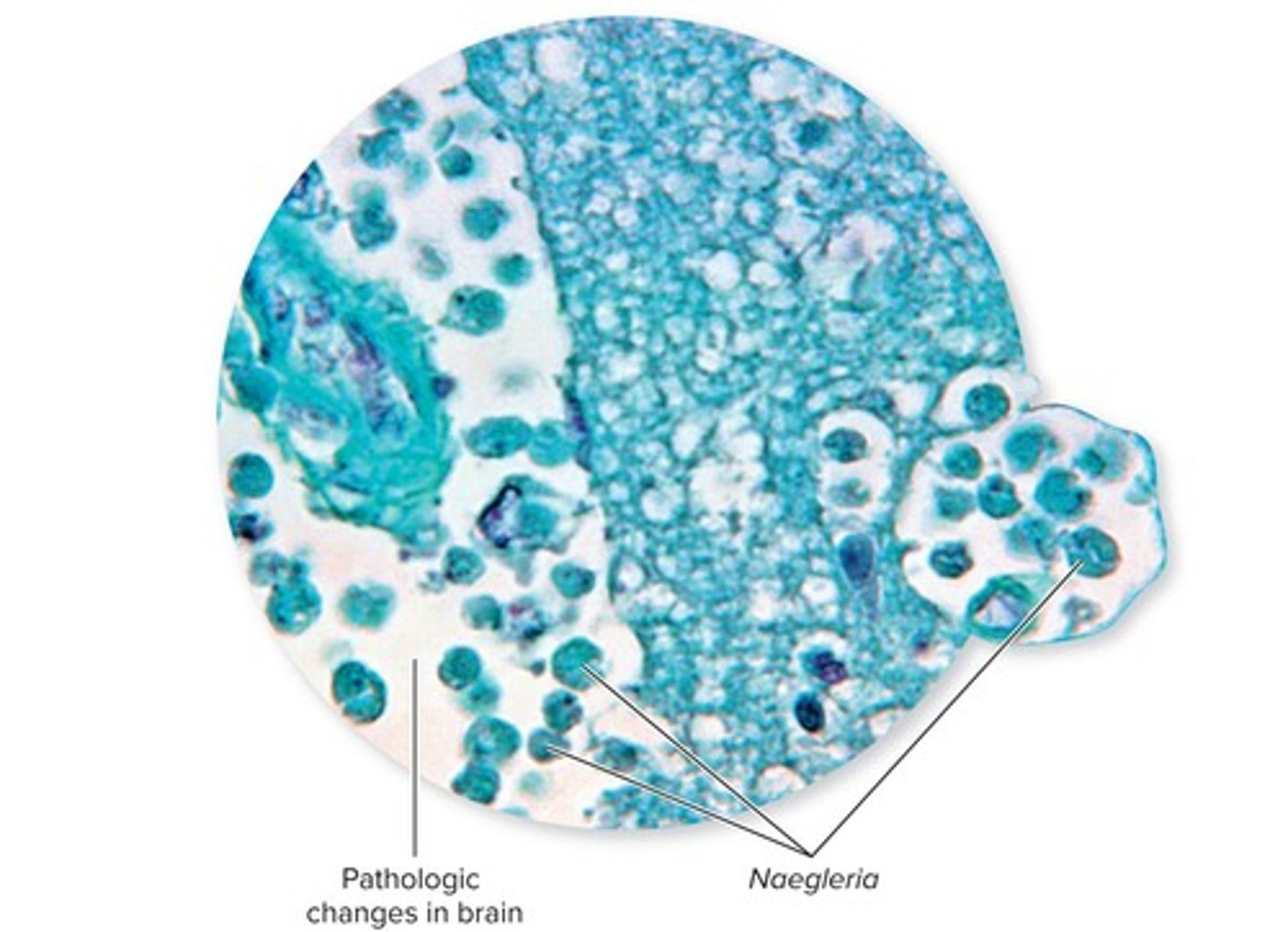 <p>A rare but severe infection caused by an amoeba that burrows into the nasal mucosa and migrates to the brain.</p>