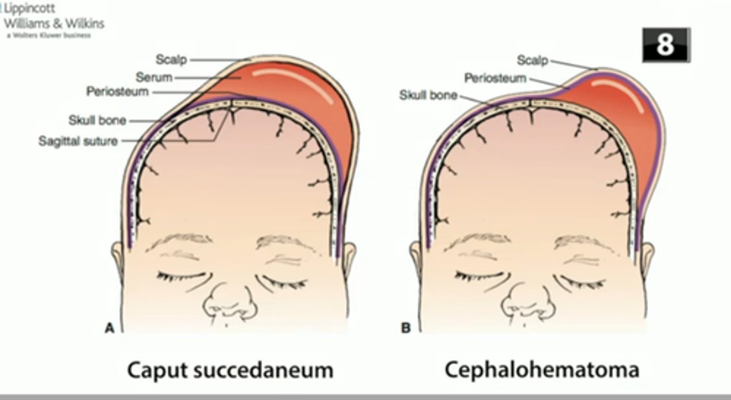<p>- Collection of blood between periosteum of skull bone and the bone itself; does not cross suture line</p><p>- Occurs on one or both sides of head; occasionally over the occipital bone</p><p>- Develops within first 24-48 hours after birth</p>