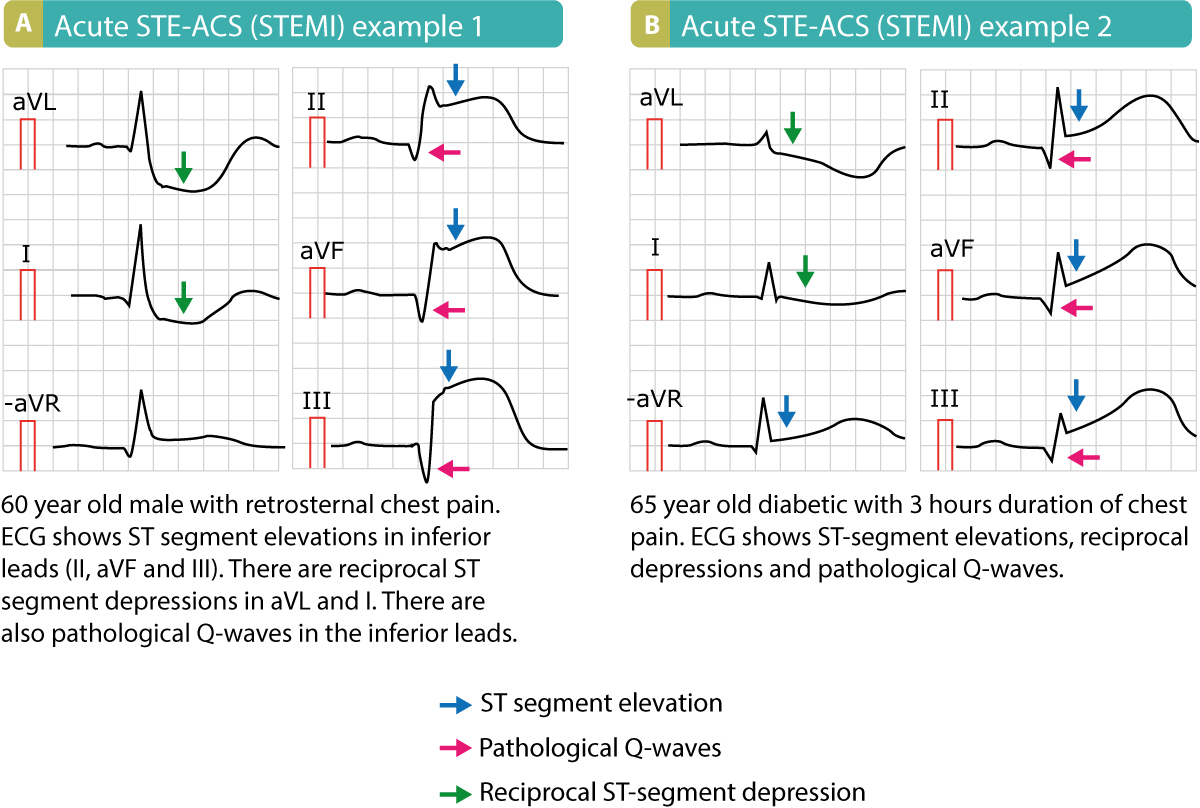 <p>Transmural injury & ischemia</p>