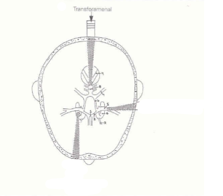 <ol><li><p>Through foramen magnum </p></li><li><p>Back of head</p></li></ol><p></p>