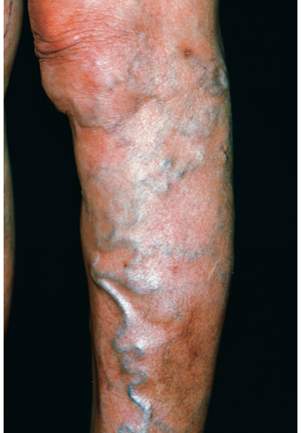 <ul><li><p><span>How would you document this patient’s veins?</span></p></li></ul><p></p>