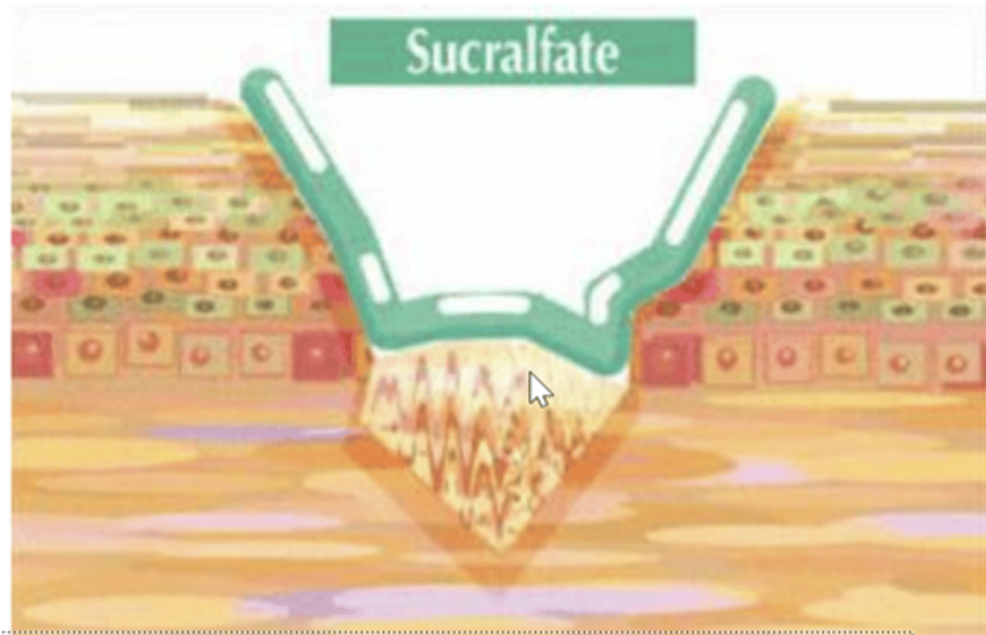 <p>creates a sticky gel that adheres to the ulcer and forms a barrier to hydrogen ions.</p>