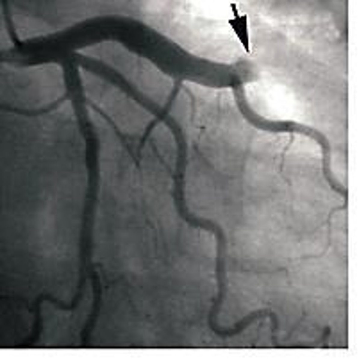 <p>Blockage of coronary arteries, reducing blood flow.</p>