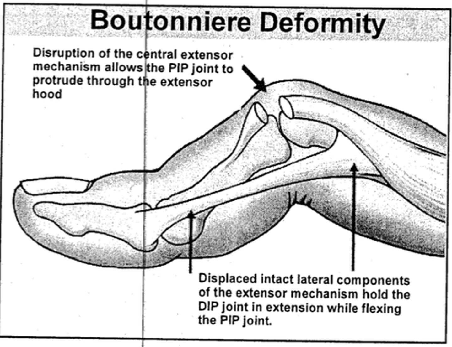 <p>boutonniere deformity →central extensor ruptures at insertion to middle phalanx</p><p>tx with PIP splint in extension</p>