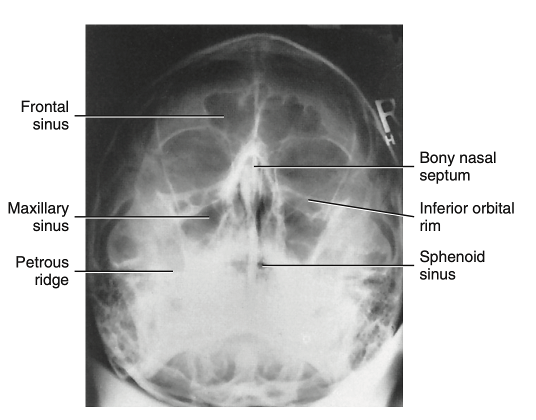 <p>How do you <u>critique</u> radiograph of <strong>Parietocanthial projection: Waters method </strong>for <strong>sinuses?</strong></p>