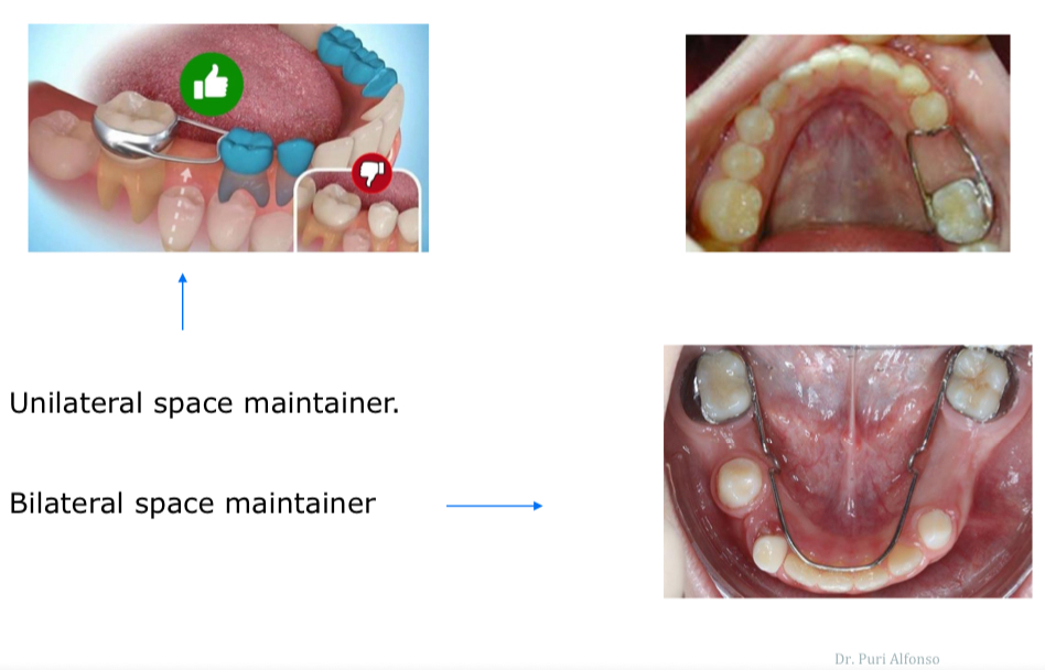 <p>Adjacent teeth drift so less space for permanent teeth to erupt</p><p>Treat by space maintainers or regain lost space with appliances</p>
