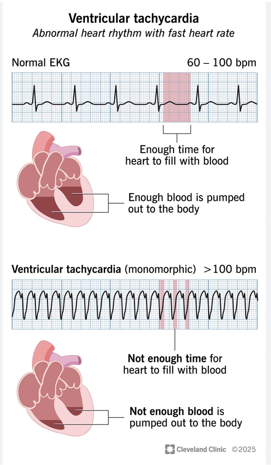 <p>A fast, potentially life-threatening heart rhythm originating from the ventricles. Immediate defibrillation is critical for unstable VT without a pulse.</p>