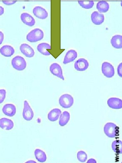 <ul><li><p>tear drop shaped RBC</p></li><li><p>if tails all face the same way = artifact </p></li></ul><p></p>