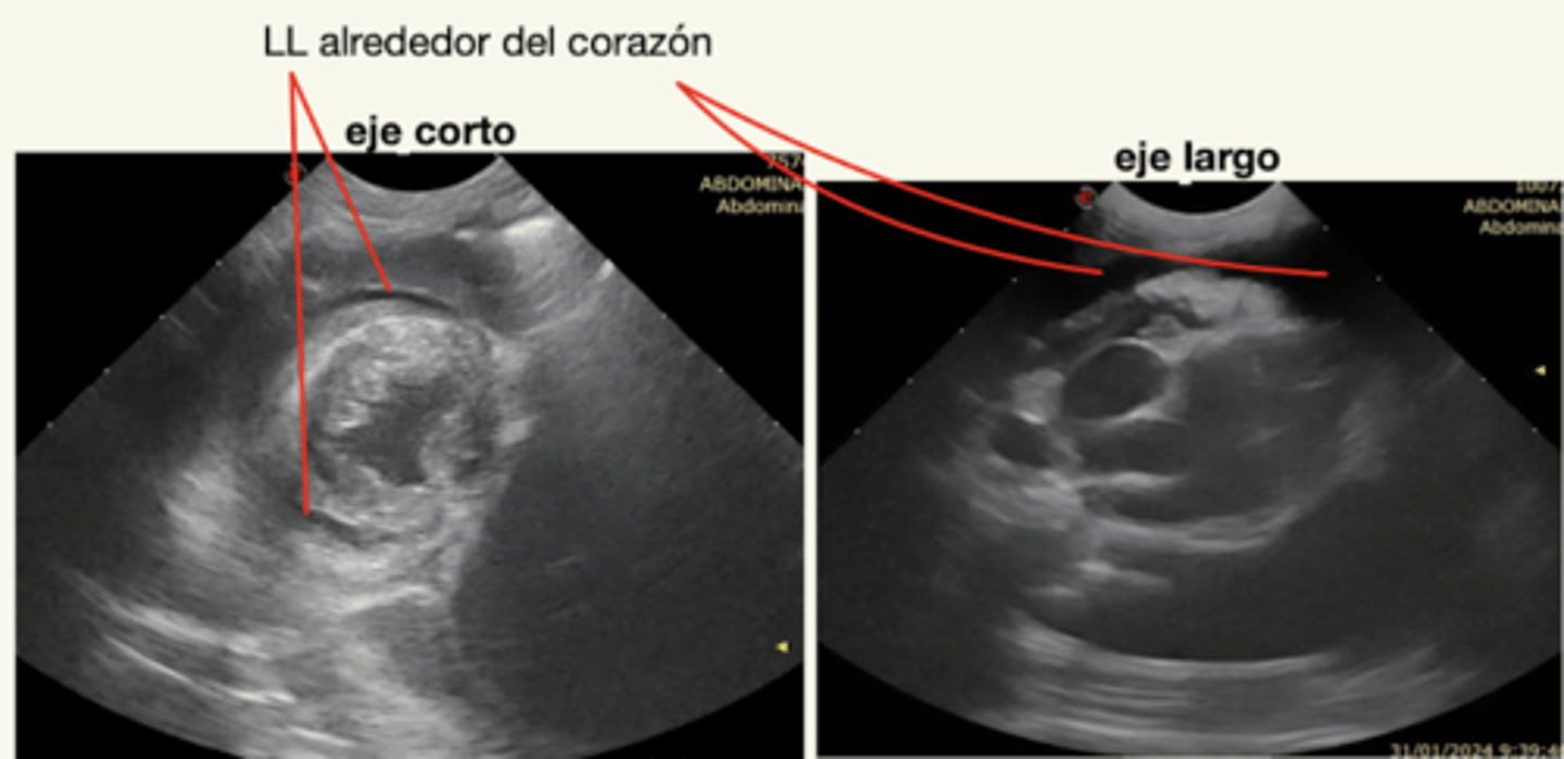 <p>espacios anecoicos alrededor del corazón.</p>