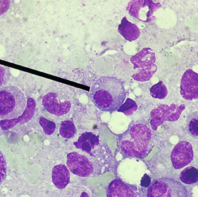 <p>Multiple myeloma can be screened by what hematology test? The result of this hematology test is usually increased or elevated.</p>