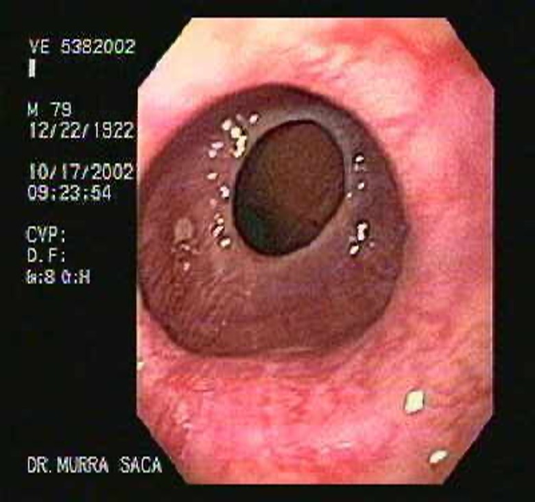 <p>What condition?</p><ul><li><p>thin, weblike constriction at/near border of LES (distal esophagus)</p></li><li><p>common cause of intermittent solid food dysphagia</p></li><li><p>worse with eating quickly and inadequate mastication</p></li><li><p>reflux sx (chronic GERD may play role)</p></li><li><p>dx: BA esophagram</p></li><li><p>rx: esophageal dilation</p></li></ul><p></p>