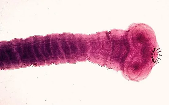 <p>in human</p><p>epigastric pain, diarrhea, intestinal obstruction, proglottid passage</p><p>history of eating undercooked pork</p><p>worldwide (endemic in C/S America, E Europe, S Asia, India, Africa)</p>