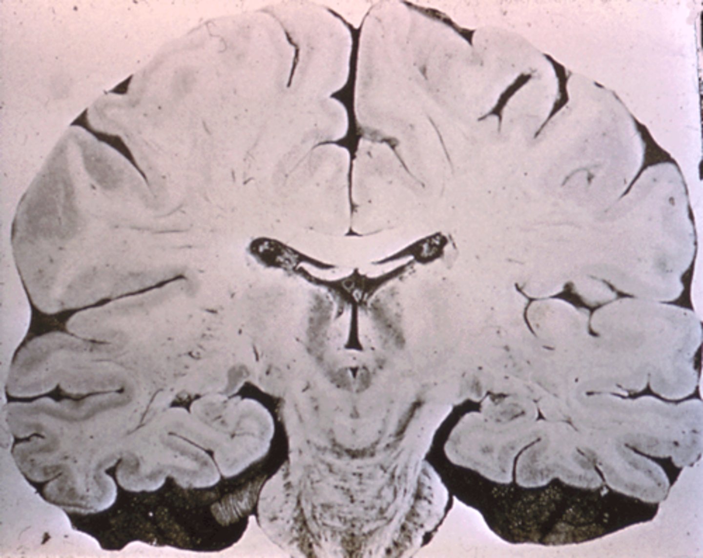 <p>Loss of contact with reality.</p>