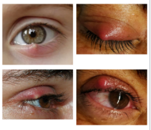 <p>symptoms of hordeolum</p>