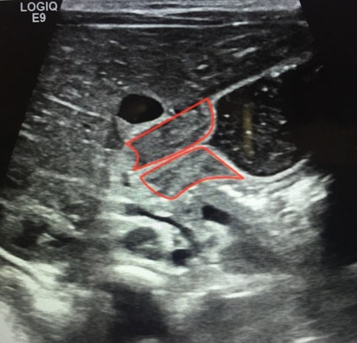 <p>Pyloromyotomy</p><p>- boys age 3-5 weeks</p><p>- projectile, non-bilious vomit, hypochloremic metabolic alkalsosis</p><p>- "olive-shaped abd mass"</p><p>- dehydration (sunken fontanel, dec skin turgor, delayed cap refill)</p><p>Abdominal US confirms diagnosis</p>