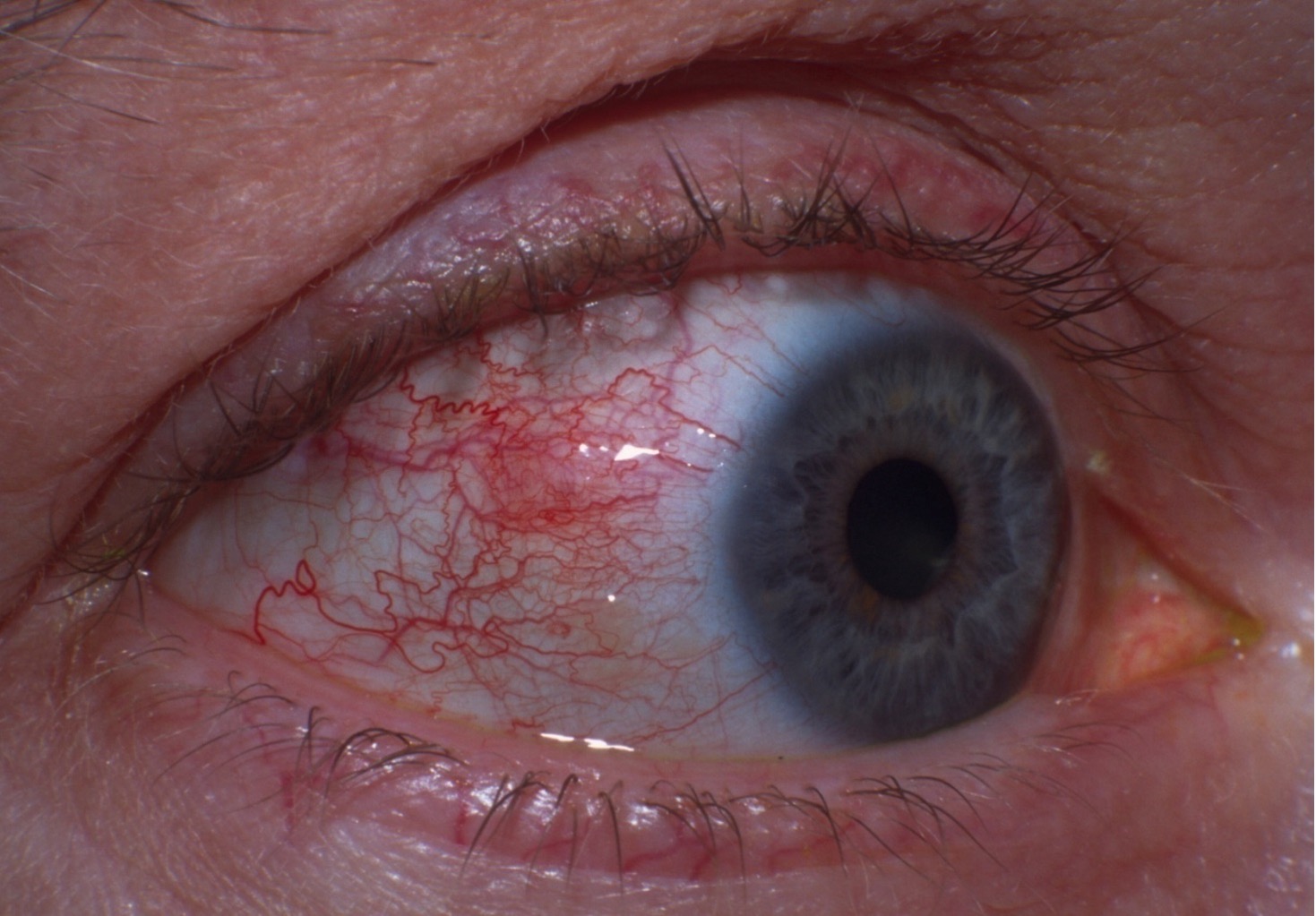 <p>What is the patient likely suffering from?</p><ul><li><p>The patient has previously had chicken pox and suffers from rheumatoid arthritis</p></li><li><p>The eye is red, tender, and achy, and has watery discharge</p></li><li><p>On slit lamp examination, there is swelling of the scleral capillaries, but the anterior chamber is clear</p></li></ul><p></p>