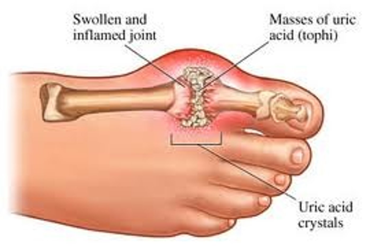 <p>Hot and swollen joints (toes are commonly affected)</p>