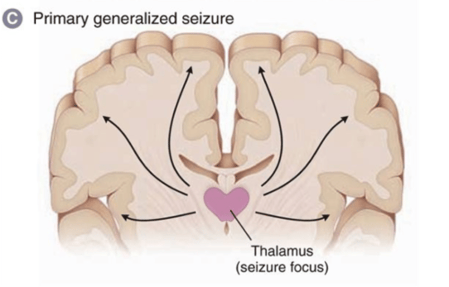 <p>Seizure focus (start) is in the thalamus</p><p>Thalamus connects the two hemispheres</p><p>Spreads to both sides</p>