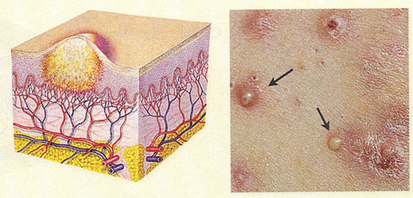 <p>Pus-filled 1 cm or less</p>