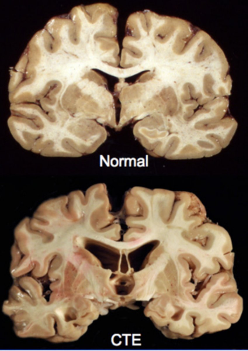 <p>Neurodegenerative disease linked to repeated head trauma over a long period of time; increased incidence of suicide &amp; spousal abuse, early dementia, Parkinson-like sxs, impaired judgement, impulsivity, &amp; other abnormalities</p>