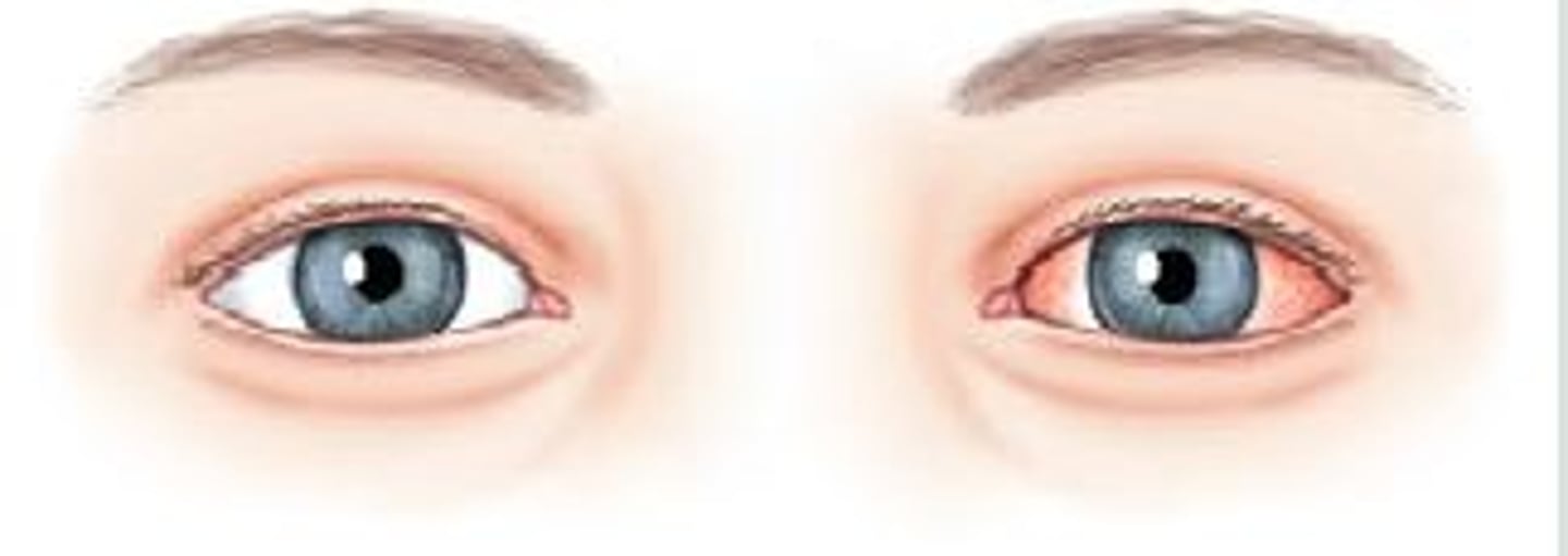 <p>Acute uveitis is commonly unilateral; constriction of pupil accompanied by pain and reddened eye, especially adjacent to the iris</p>