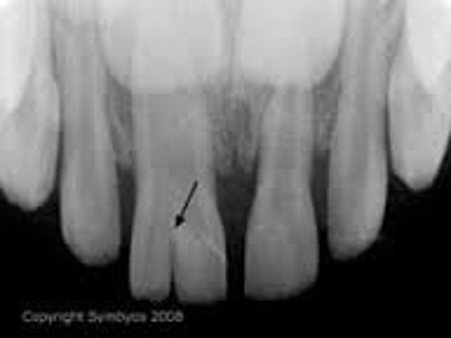 <p>-Two teeth have developed from a single root.</p><p>-Teeth in the arch are normal count</p>