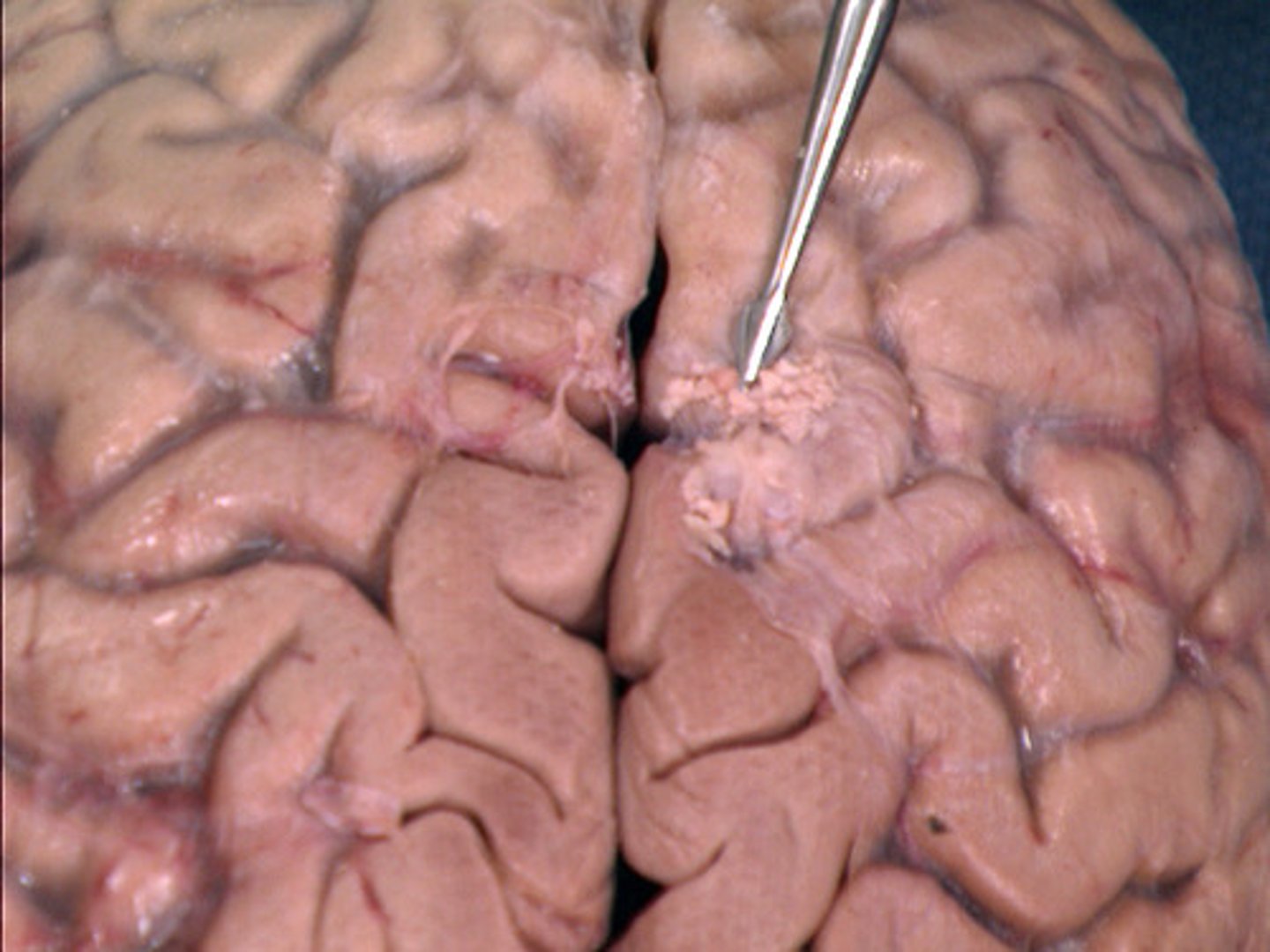 <p>-extra credit</p><p>-along longitudinal fissure</p>