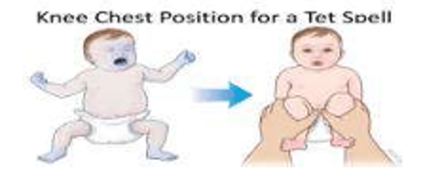 <p>If baby is experiencing tet spells:</p><p>- Lift knee to chest or squats (for older children): Bringing the infant’s knees tightly to the chest or Squatting increases the systemic vascular resistance, it decreases the right to left shunting which is going to improve the blood flow and help increase the oxygen level.</p><p>Temporary Shunt Operation:</p><p>- Babies who are not strong enough for a full repair or have other underlying health problems may have a shunt operation or a palliative surgery. A shunt is a tube that is sewn into place between the aorta and the pulmonary artery. It helps blood flow to the lungs. A shunt operation is not permanent; babies with a shunt still need a full repair surgery later.</p><p>Open-Heart surgery or Complete/Full repair: </p><p>- This procedure is usually done in the first year of life. The surgeon patches the hole between the lower heart chambers and repairs or replaces the pulmonary valve. The surgeon may remove thickened muscle below the pulmonary valve or widen the smaller lung arteries.</p>