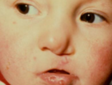 <p>genetic disorder characterized by LIP PITS, and cleft lip and/or palate</p>