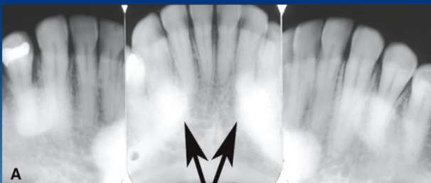 <p>likely diagnosis of these radiopaque lesions</p>