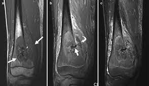 <p>Osteogenic sarcoma generally occurs in the end of a long bone in the metaphysis \n (especially about the knee). It is a malignant tumor of osteoblasts, which produce osteoid and spicules of calcified \n bone. It is most common in persons between 10 to 25 years old. \n Smaller peak incidence is seen in older persons who have a preexisting bone disorder, particularly Paget’s disease.</p>