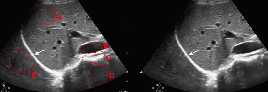 <p>State the ultrasound phenomena in the indicated area (specular reflection, transmission, scattering, enhancement, shadowing)</p>